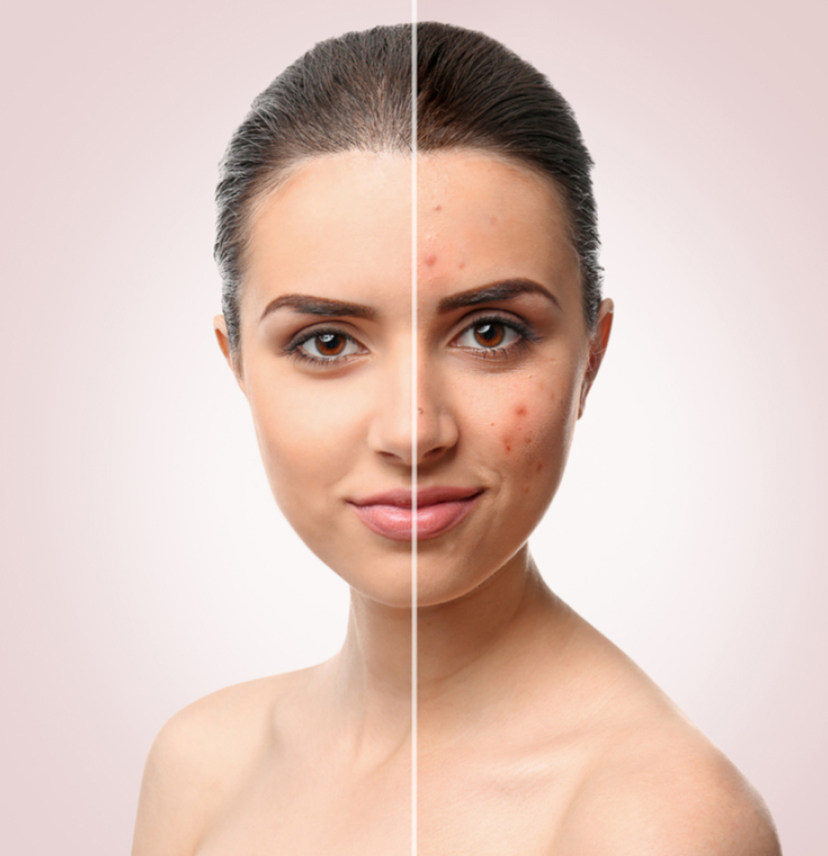 Acne Treatments