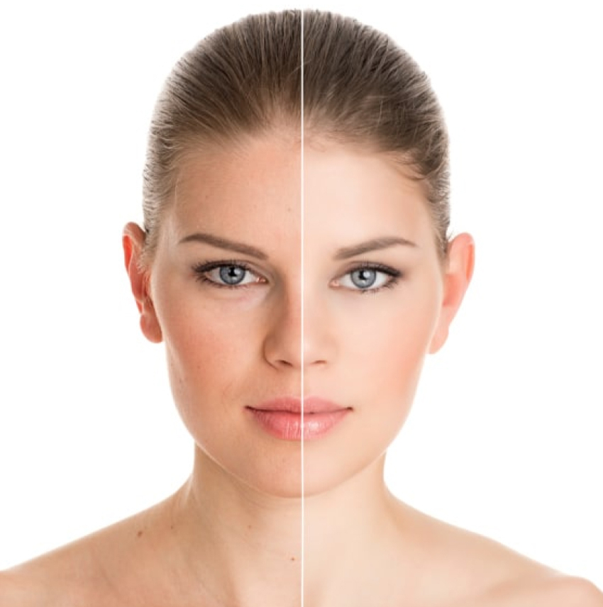 Skin Rejuvenation