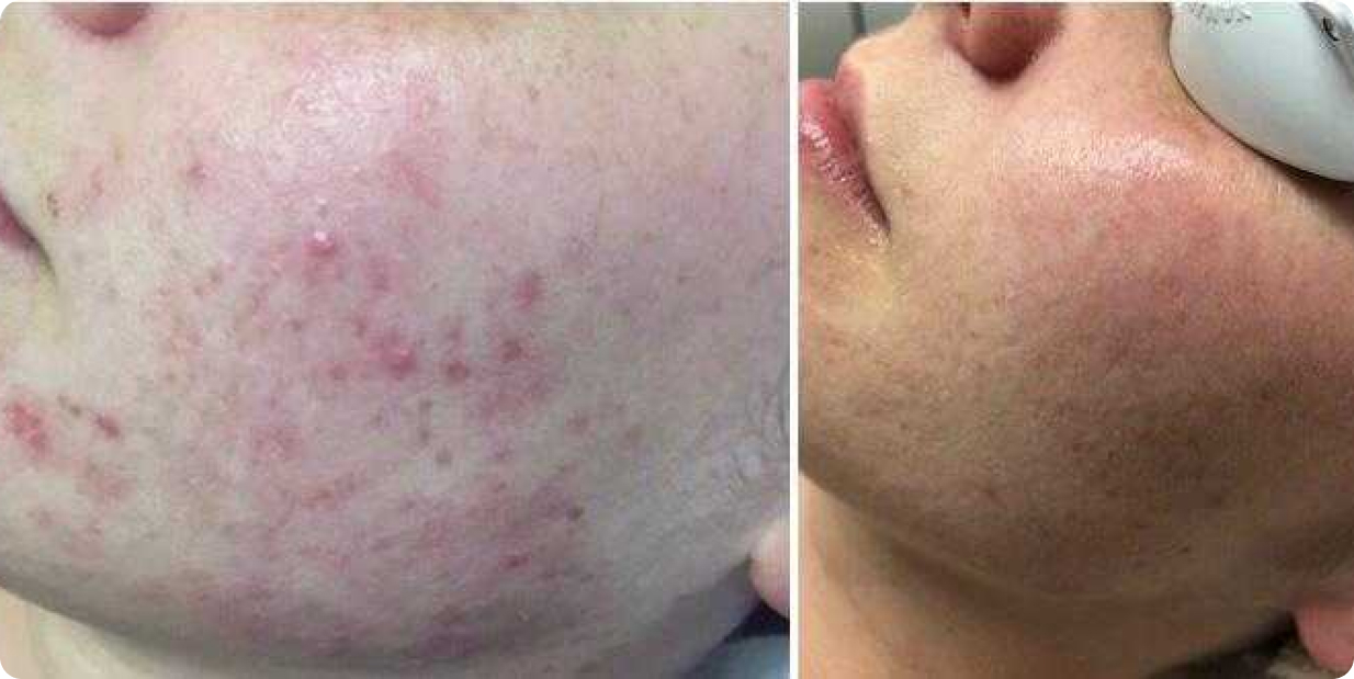 IPL Photorejuvenation Treatment