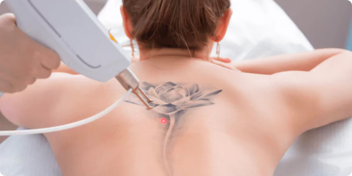 Tattoo Removal Process