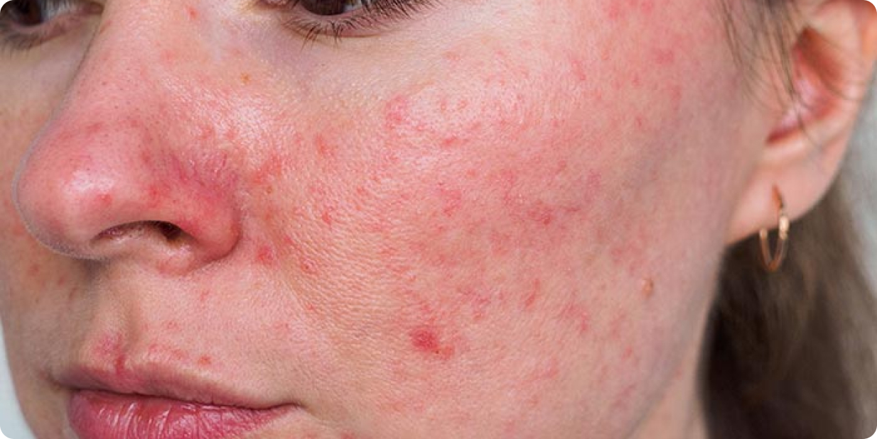 More about IPL Treatment