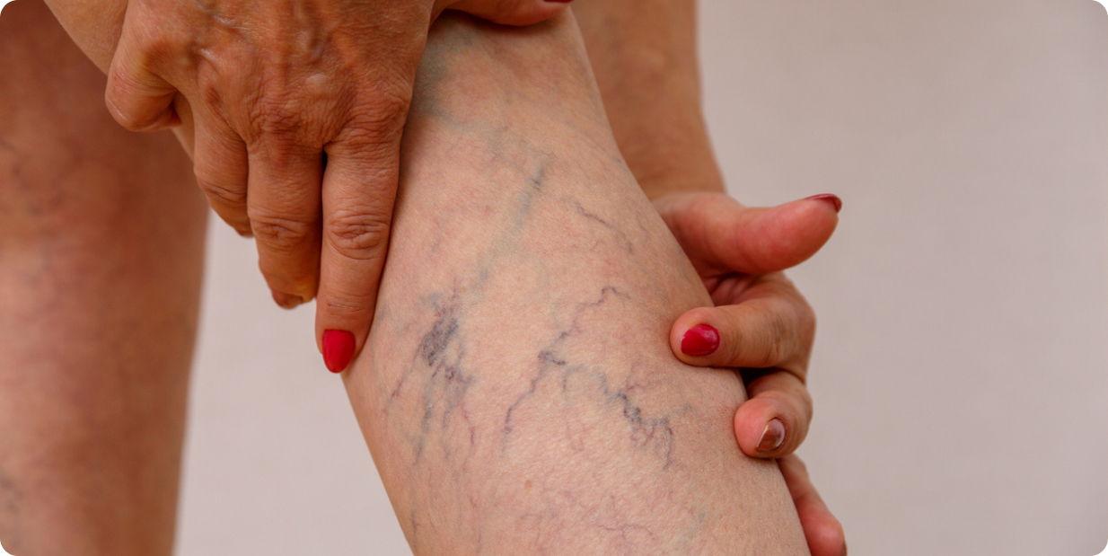 Small Veins and Vascular Lesions Treatment