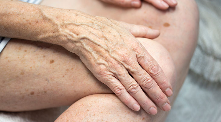 Dark/Age Spots Treatment