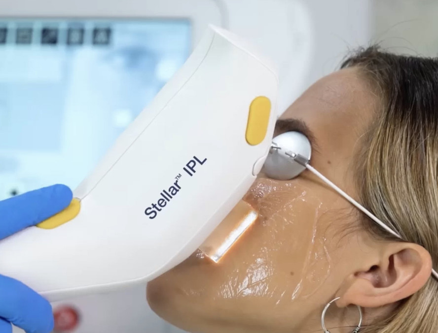 IPL Photorejuvenation Treatment
