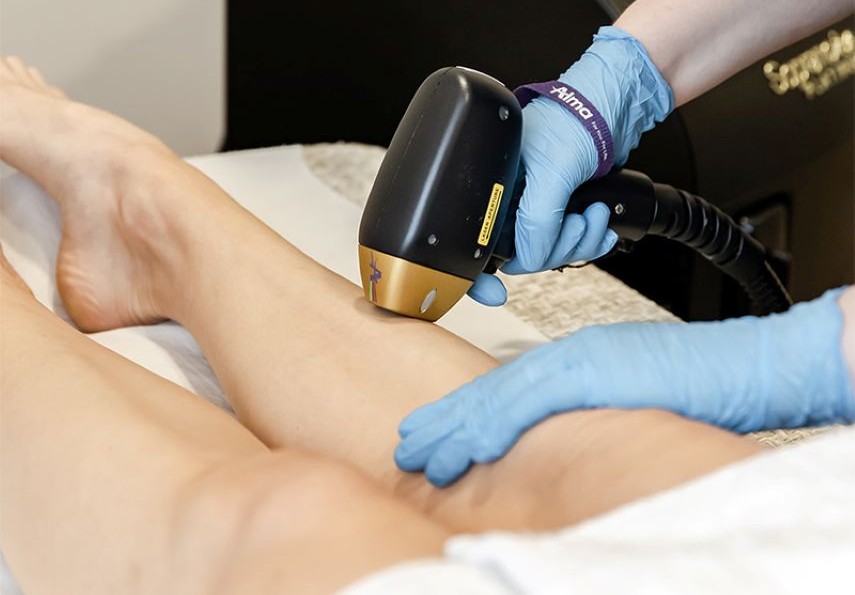 Laser Hair Removal